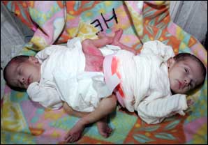 Le Matin Bebes Siamois A L Hopital Avicenne De Rabat