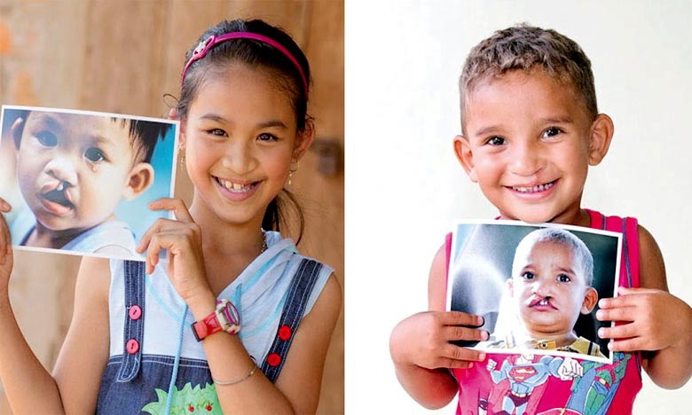 «Opération Smile Morocco» réalise 1.500 consultations le premier jour
