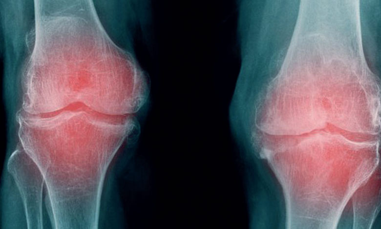 Journée mondiale de l’arthrose : Mieux vaut prévenir que guérir