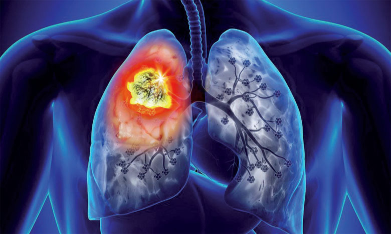 Pfizer lance une campagne de sensibilisation au cancer du poumon