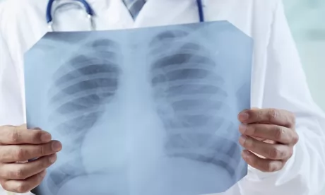 Tuberculose : Mobilisation de l’Association des pneumologues privés