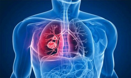 Tuberculose : avec 7.430 cas en 2021, Casablanca-Settat toujours en tête des régions les plus touchées