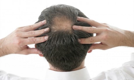 Chute des cheveux : Un médicament contre l’alopécie autorisé aux Etats-Unis