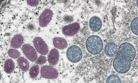 Etats-Unis : deux cas de variole du singe détectés pour la première fois chez les enfants 