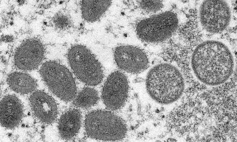 Officiel : Un cas confirmé de la variole du singe au Maroc