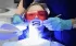 Blanchiment dentaire, un acte médical à ne pas prendre à la légère (Avis d'expert) 